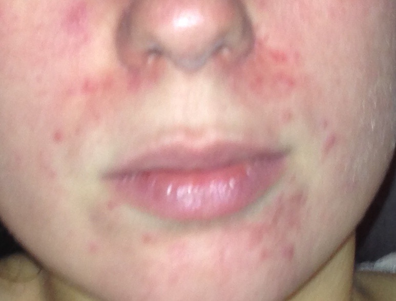 Download Pickel Im Mundwinkel Kind Images