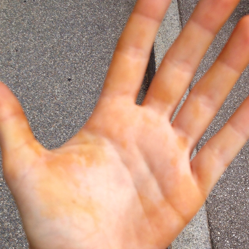 Ausschlag schonmal jemand gesehen/ Erfahrungen? (krank, Füße, Hand)