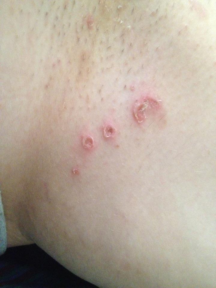 Ausschlag, Allergie, Blasen? Intimbereich (Arzt, Schmerzen, Verletzung)