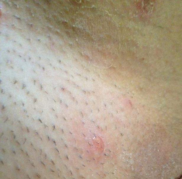 Ausschlag, Allergie, Blasen? Intimbereich (Arzt, Schmerzen, Verletzung)
