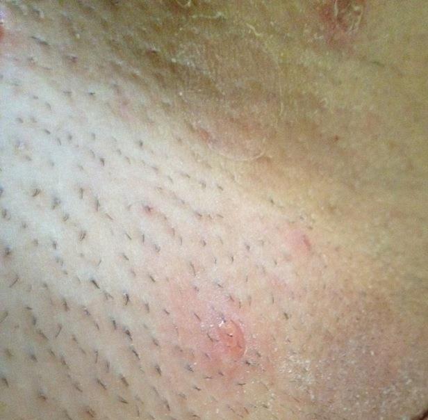 Ausschlag, Allergie, Blasen? Intimbereich (Schmerzen, Arzt, Verletzung)