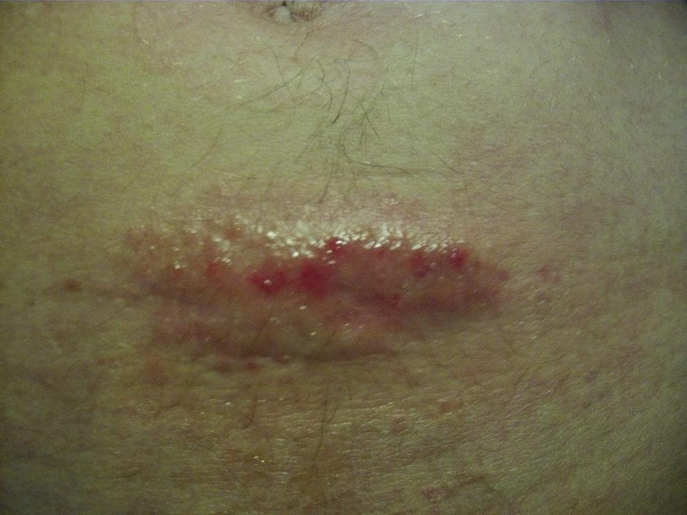 Ausschlag am Bauch. Was ist das? (Haut, Allergie) Ausschlag am Bauch. Was ist das? (Haut, Allergie)