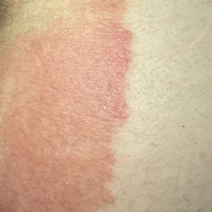 Ausschlag am Bein hilfe? (Gesundheit und Medizin, Arzt, Haut) Ausschlag am Bein hilfe? (Gesundheit und Medizin, Arzt, Haut)