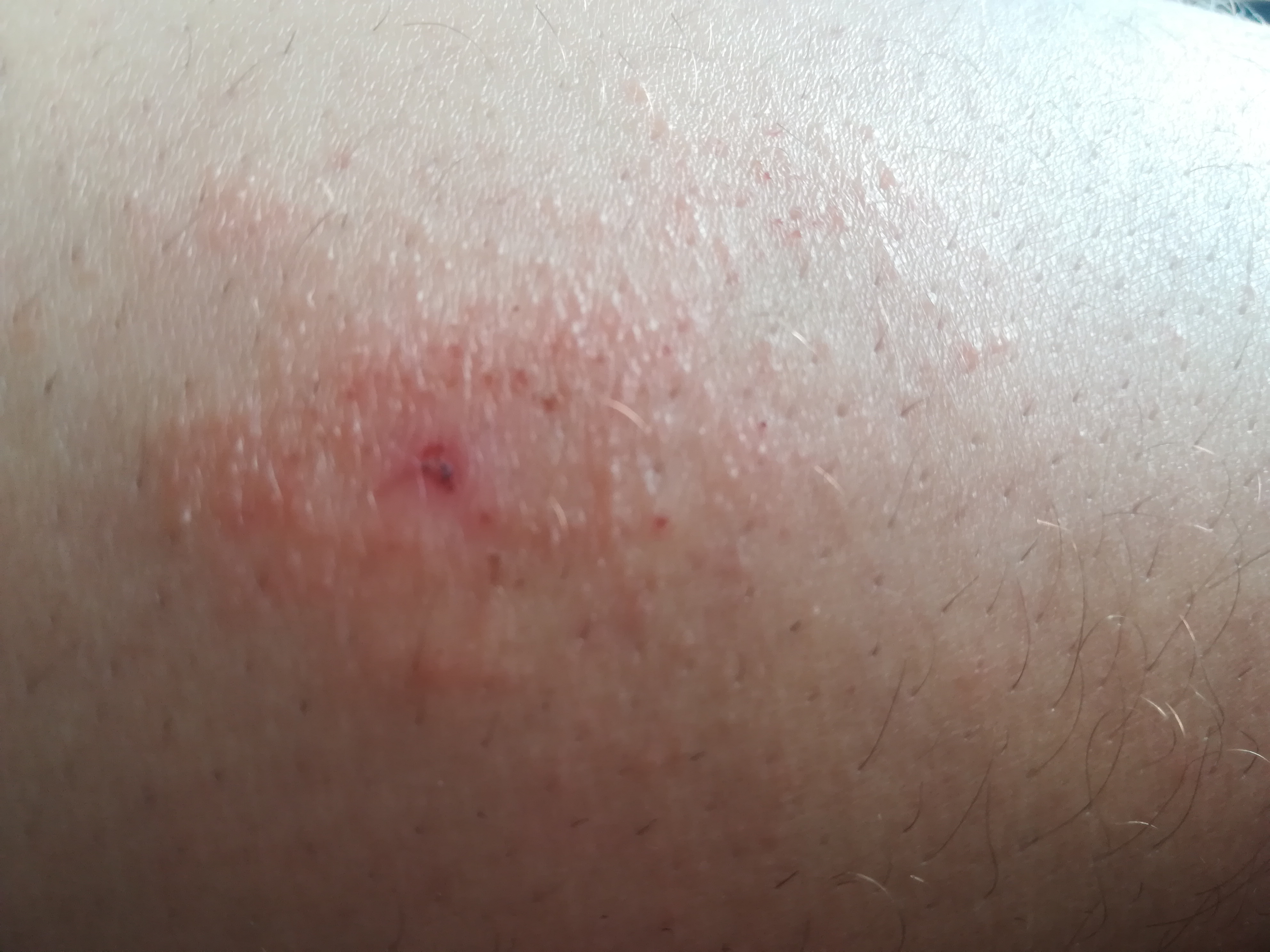 Ausschlag am Bein mini pickelchen? (Medizin) Ausschlag am Bein mini pickelchen? (Medizin)