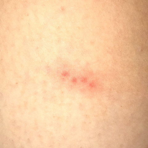 Ausschlag Am Bein Rote Punkte Gesundheit Und Medizin Arzt Haut Ausschlag Am Bein Rote Punkte Gesundheit Und Medizin Arzt Haut