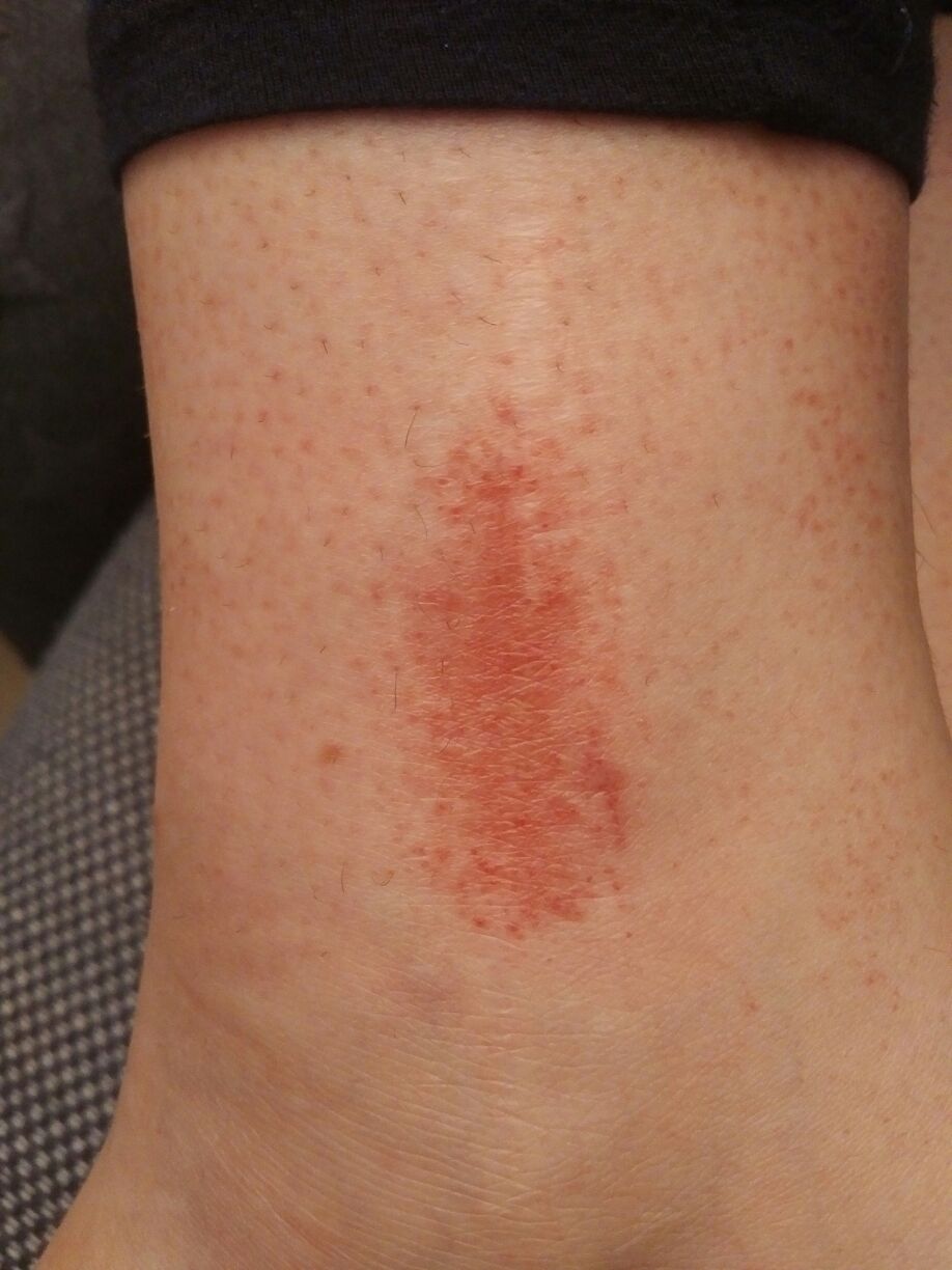 Ausschlag am Bein, was kann es sein? (Gesundheit und Medizin, Narben Ausschlag am Bein, was kann es sein? (Gesundheit und Medizin, Narben