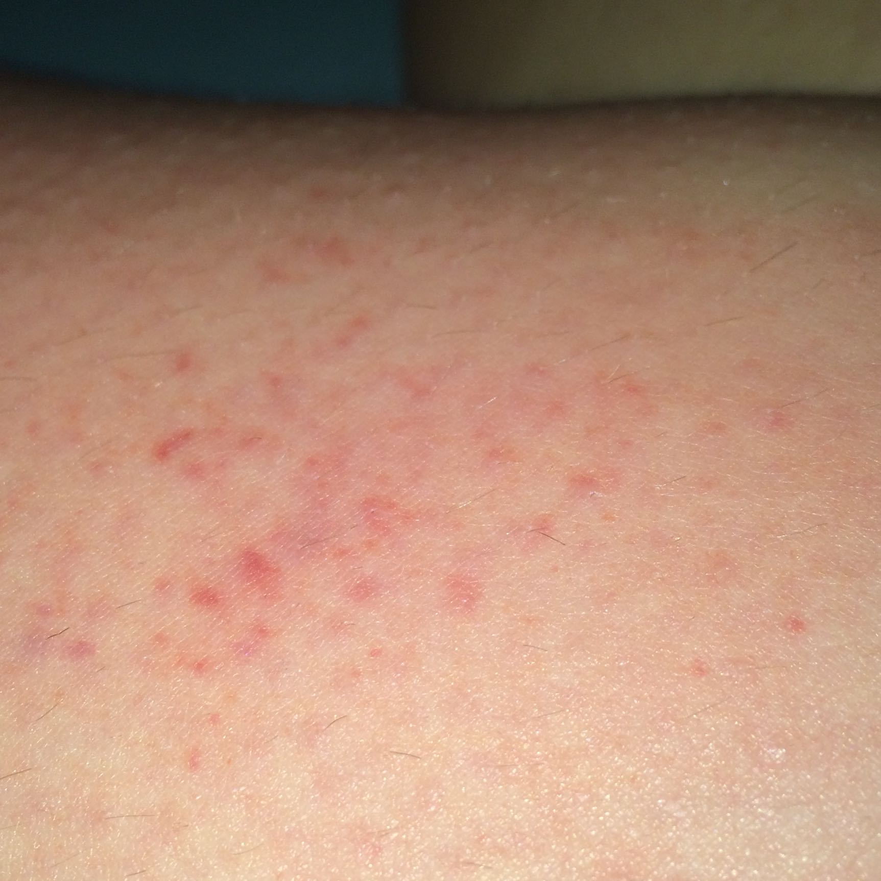 Ausschlag am Bein0.0? (Beine) Ausschlag am Bein0.0? (Beine)