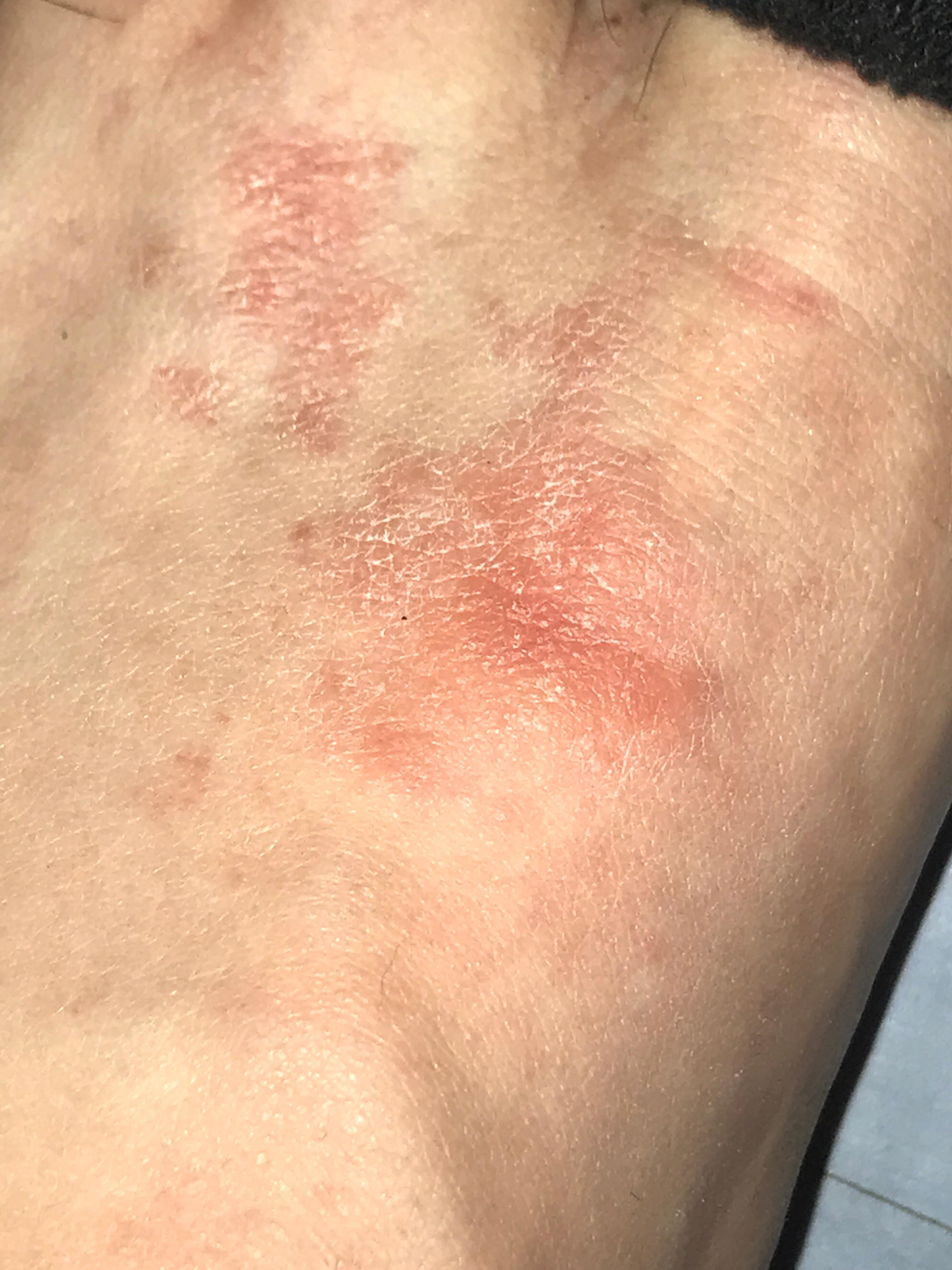 Juckender Ausschlag An Den F??En - nasas ani