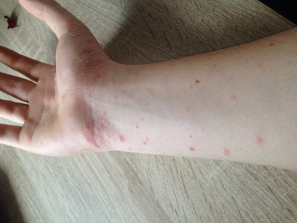 Ausschlag Am Ganzen Korper Keine Besserung Trotz Vom Arzt Verschriebener Salbe Juckreiz Ausschlag Am Ganzen Korper Keine Besserung Trotz Vom Arzt Verschriebener Salbe Juckreiz