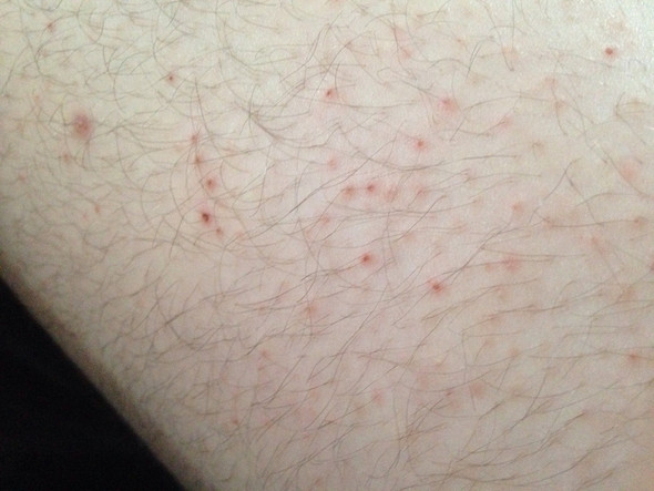 Ausschlag Am Ganzen Korper Keine Besserung Trotz Vom Arzt Verschriebener Salbe Juckreiz Ausschlag Am Ganzen Korper Keine Besserung Trotz Vom Arzt Verschriebener Salbe Juckreiz