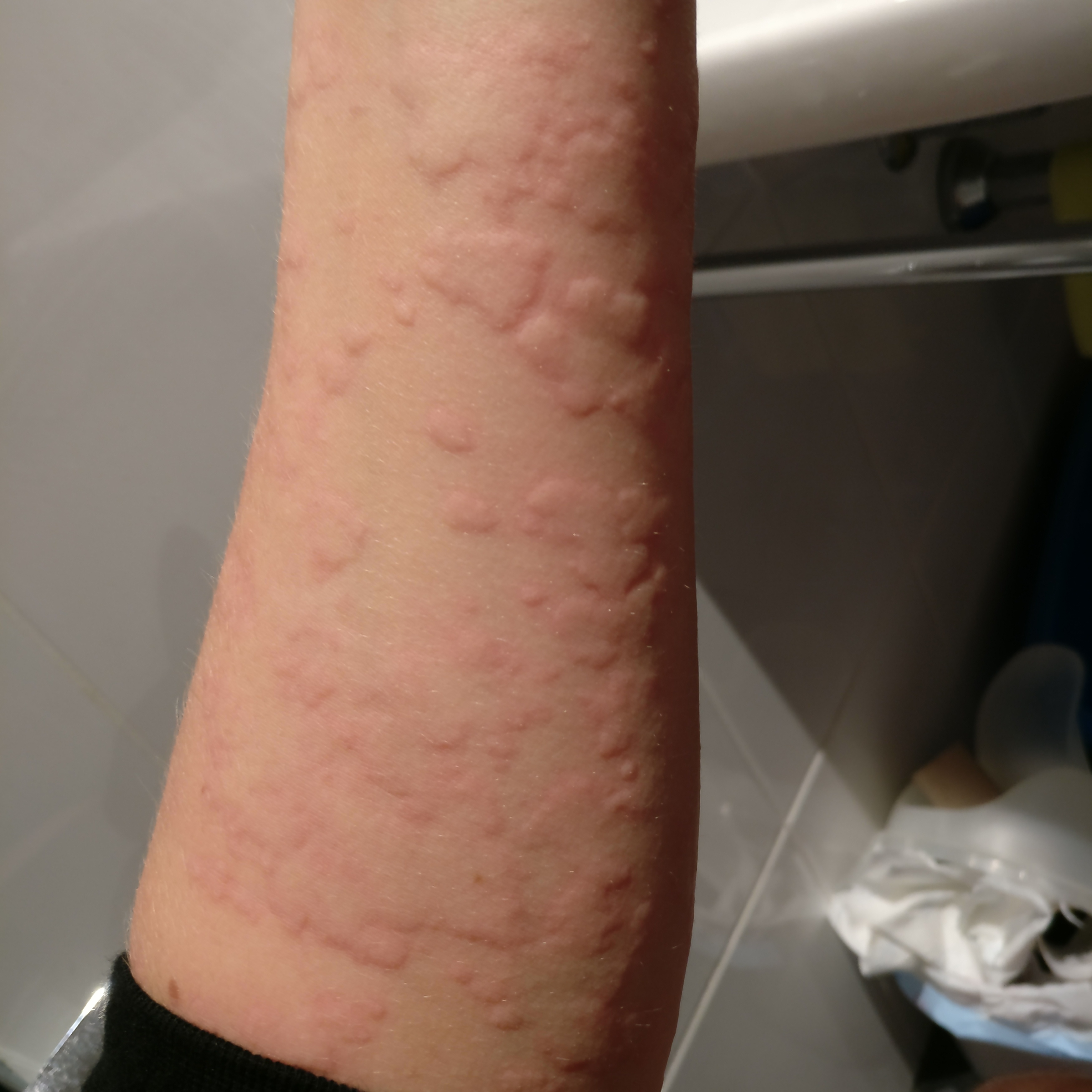 Haut Sticht Und Juckt Ohne Ausschlag
