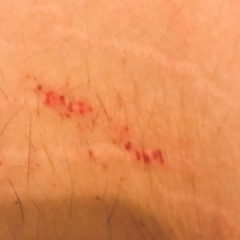 Ausschlag Am Korper Mit Juckreiz Was Ist Das Gesundheit Und Medizin Milben Hautausschlag Ausschlag Am Korper Mit Juckreiz Was Ist Das Gesundheit Und Medizin Milben Hautausschlag