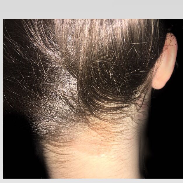 Ausschlag am Nacken? (Gesundheit, Mädchen, Medizin) pickel am haaransatz im nacken