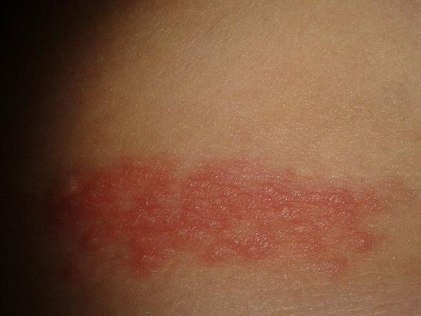 Ausschlag Am Oberkorper Idee Korper Schmerzen Ausschlag Am Oberkorper Idee Korper Schmerzen