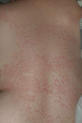 Ausschlag am Rücken? (Gesundheit und Medizin, Haut)