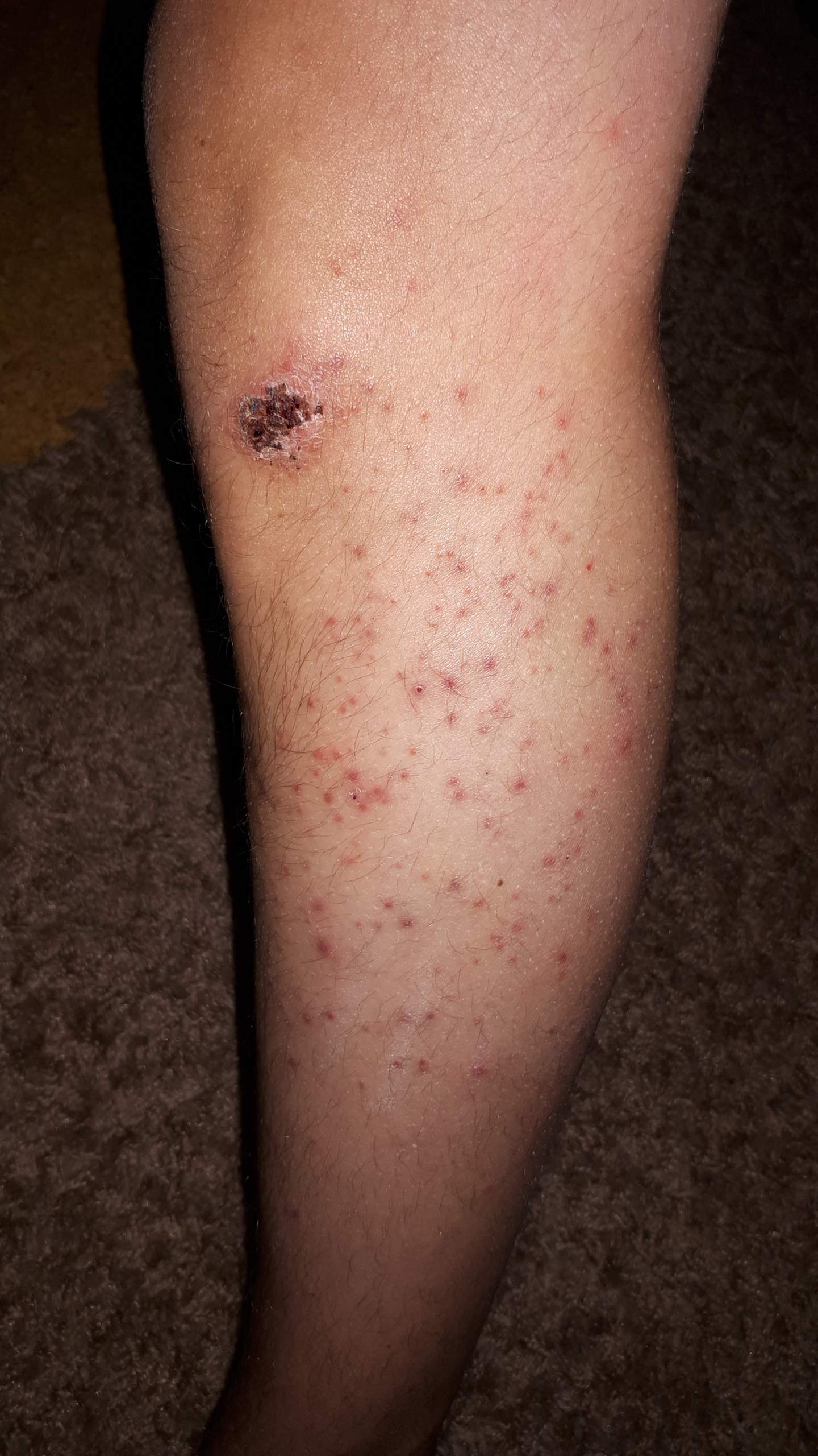Ausschlag am Unterschenkel, was kann das sein? (Arzt, Haut, Dermatologie)