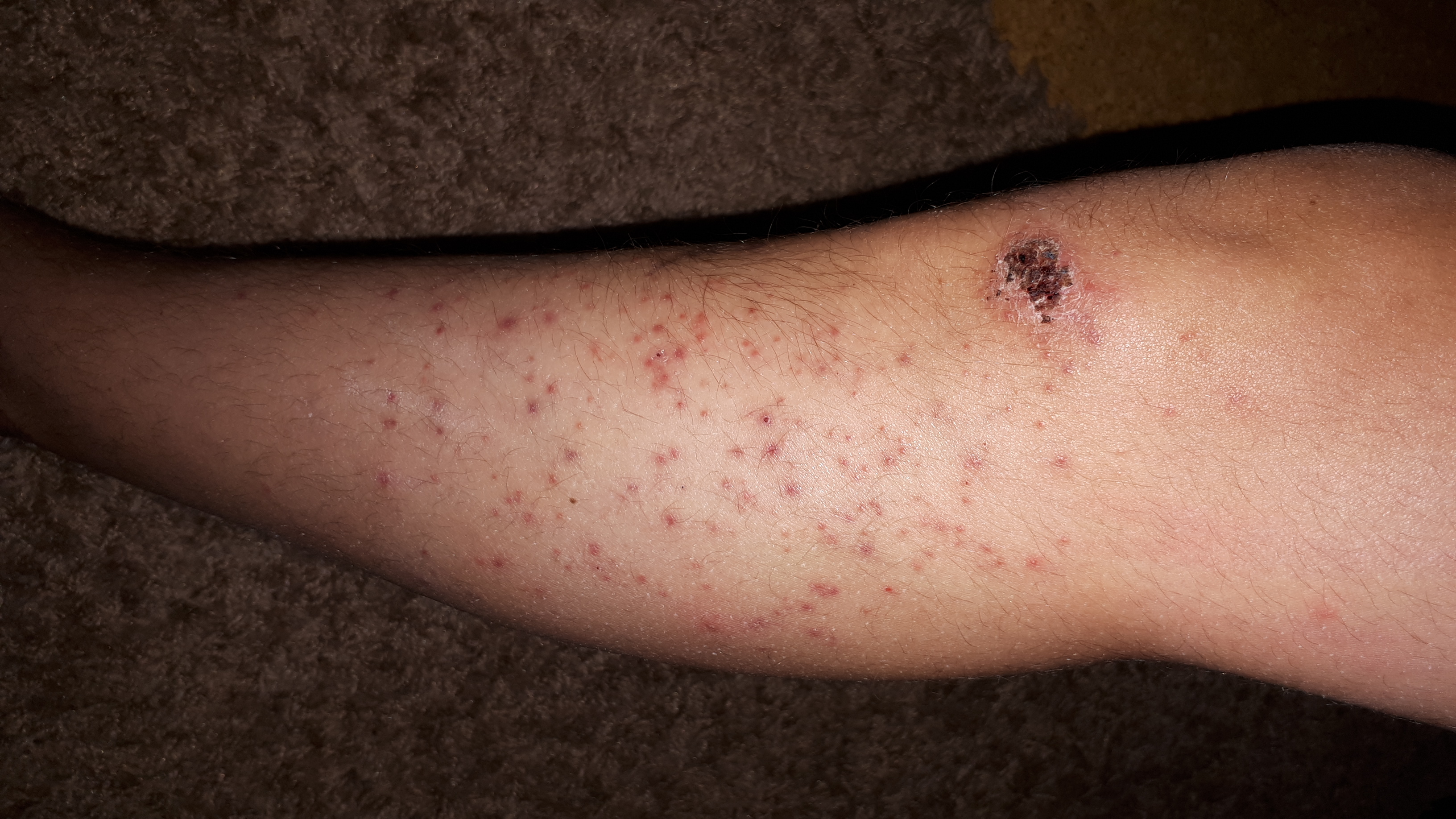 Ausschlag am Unterschenkel, was kann das sein? (Arzt, Haut, Dermatologie)