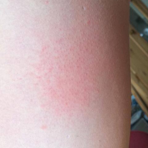 Ausschlag An Den Schenkeln Was Kann Ich Dagegen Tun Sport Arzt Beine Ausschlag An Den Schenkeln Was Kann Ich Dagegen Tun Sport Arzt Beine