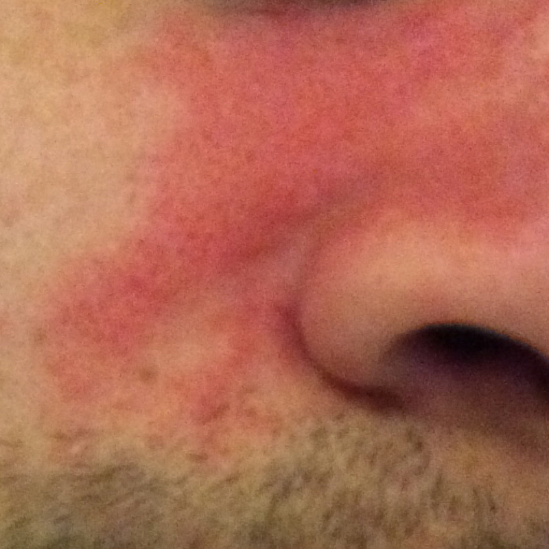 Ausschlag an der Nase! Was tuhn?