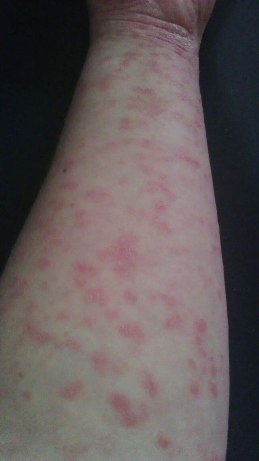 Ausschlag der sich immer mehr ausbreitet und juckt? (Gesundheit, Haut