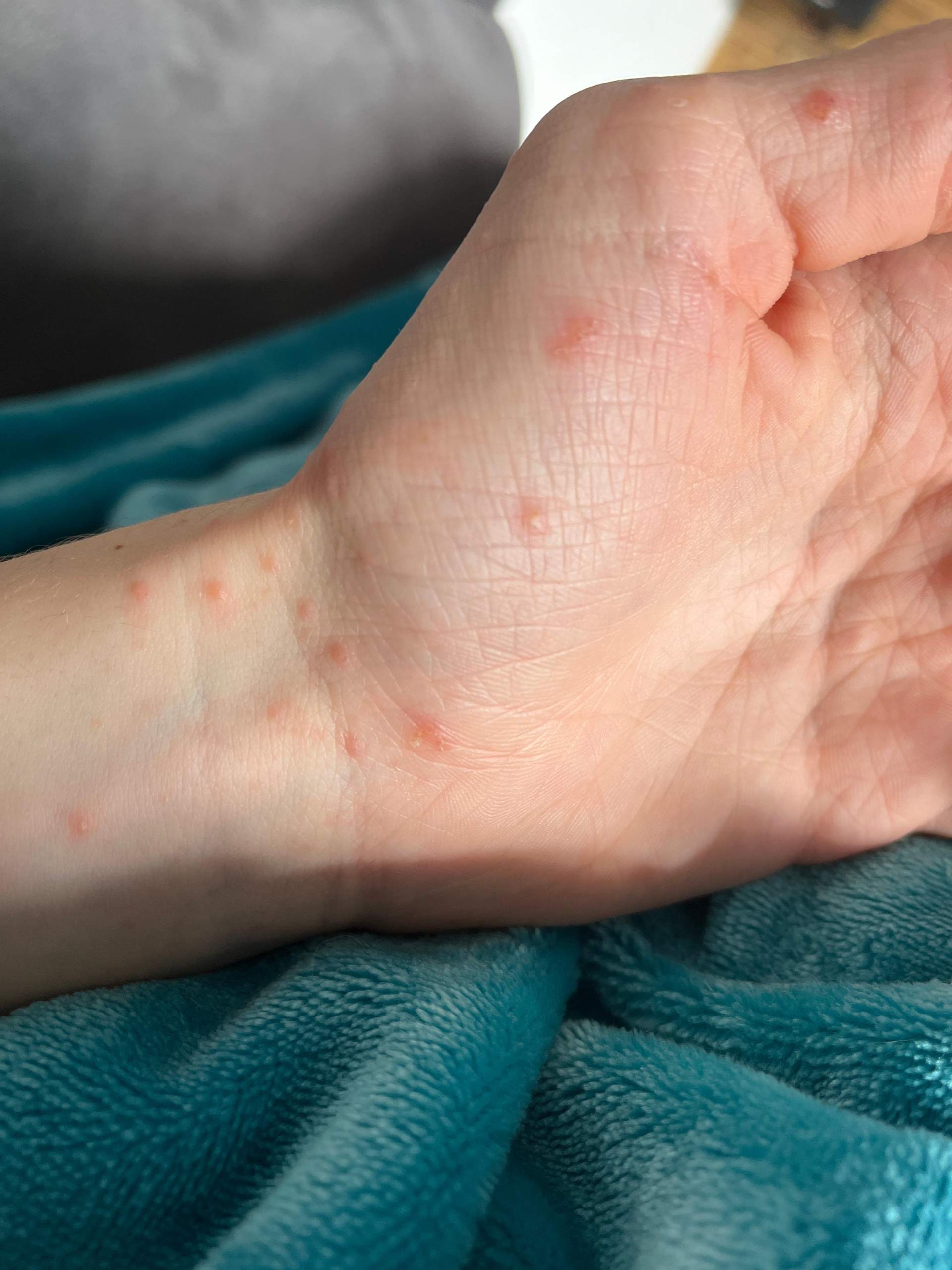 Ausschlag an hand und körper? (Gesundheit und Medizin, Haut, Pickel) pickel hand