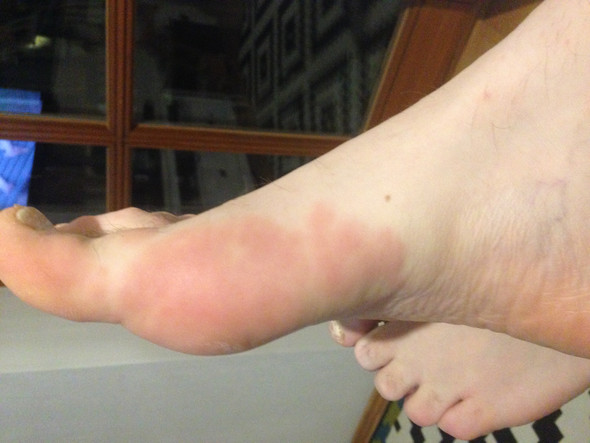 Ausschlag An Handflachen Und Fusssohlen Und Juckreiz Am Ganzen Korper Pilze Psoriasis Quaddeln Ausschlag An Handflachen Und Fusssohlen Und Juckreiz Am Ganzen Korper Pilze Psoriasis Quaddeln