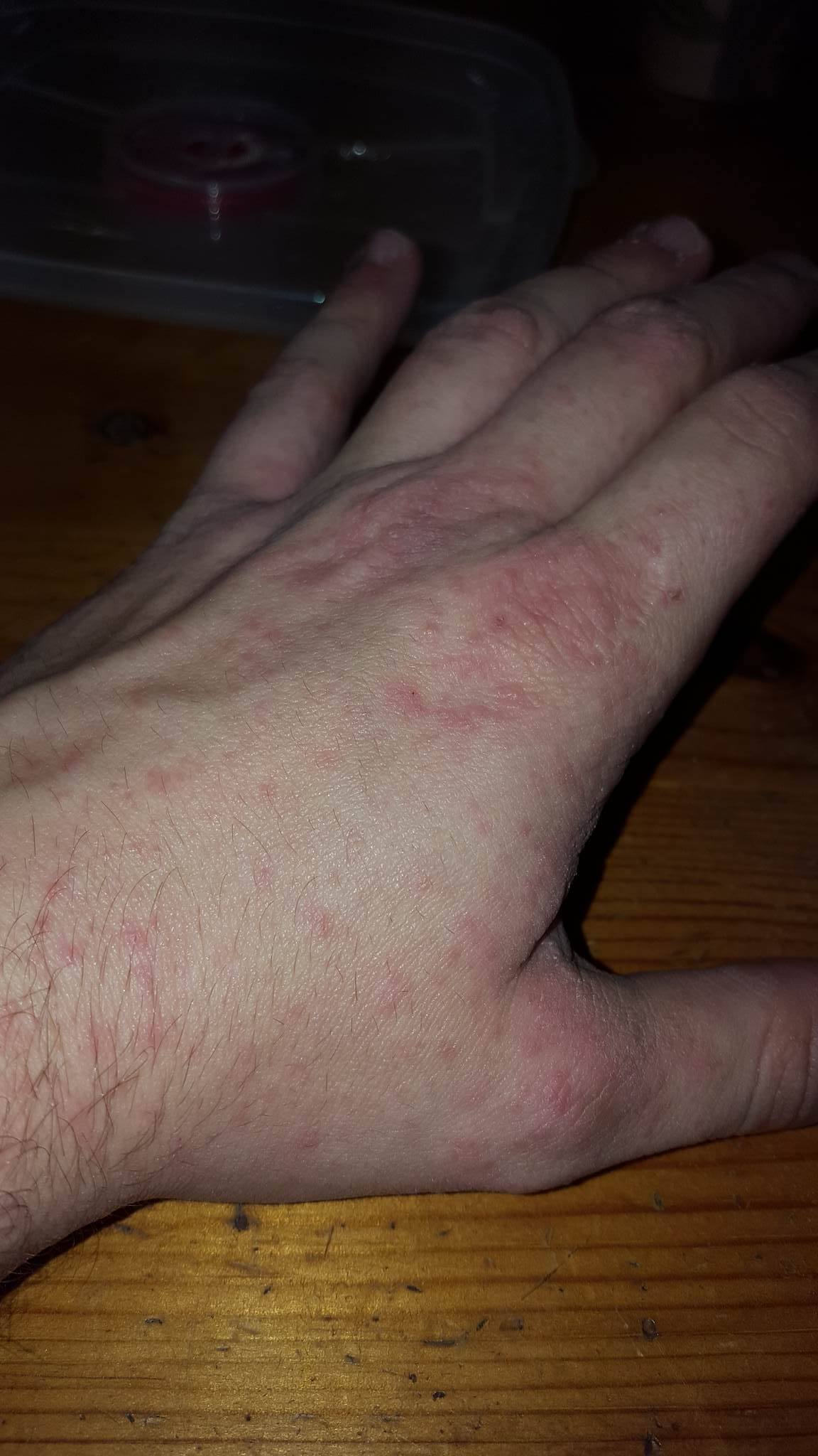 Ausschlag an linker Hand und Juckreiz am ganzen Körper? (rote-punkte