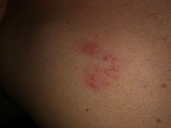 Ausschlag Auf Brust Gesundheit Und Medizin Ausschlag Auf Brust Gesundheit Und Medizin