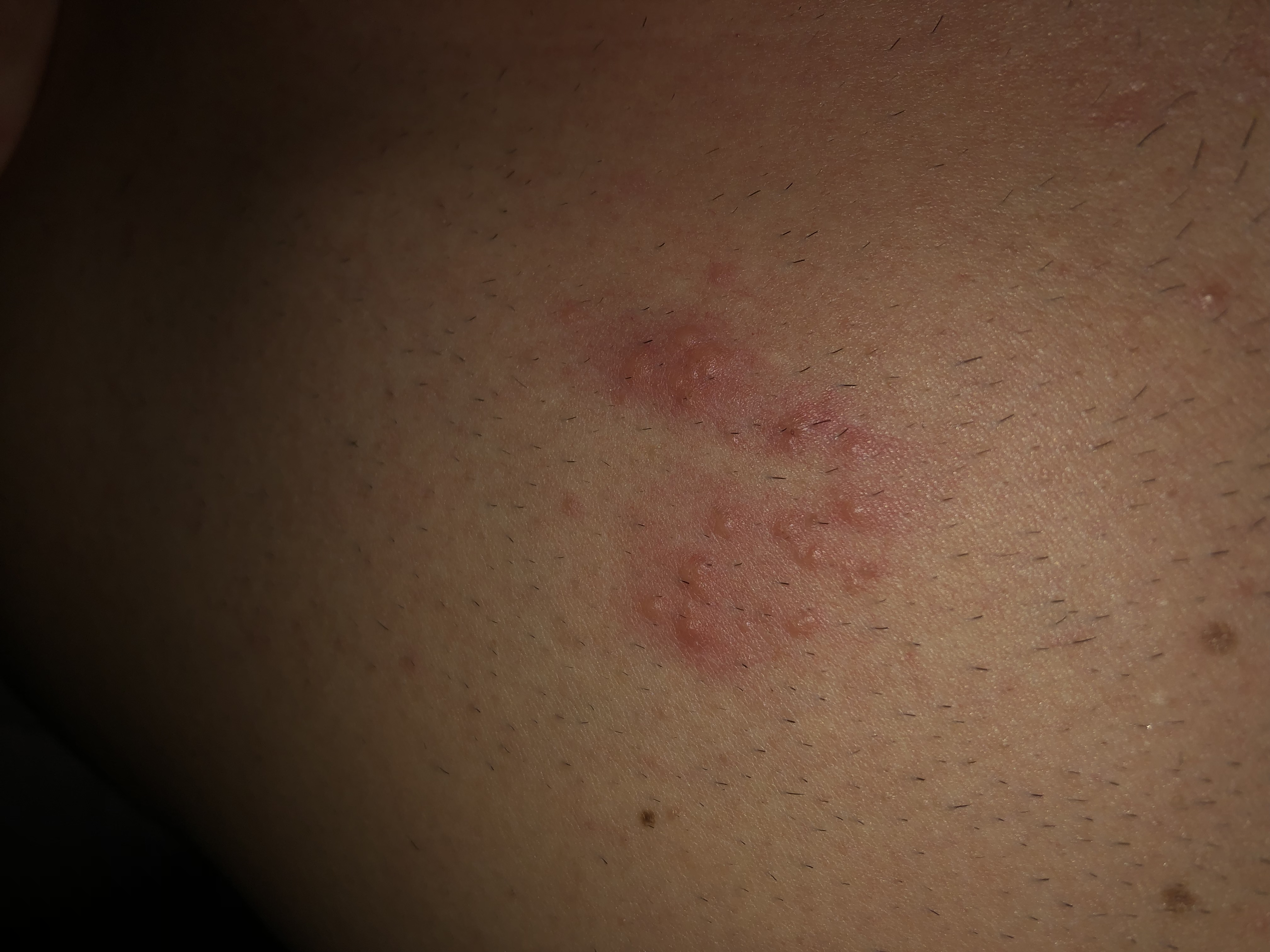 Ausschlag Auf Brust Gesundheit Und Medizin Ausschlag Auf Brust Gesundheit Und Medizin