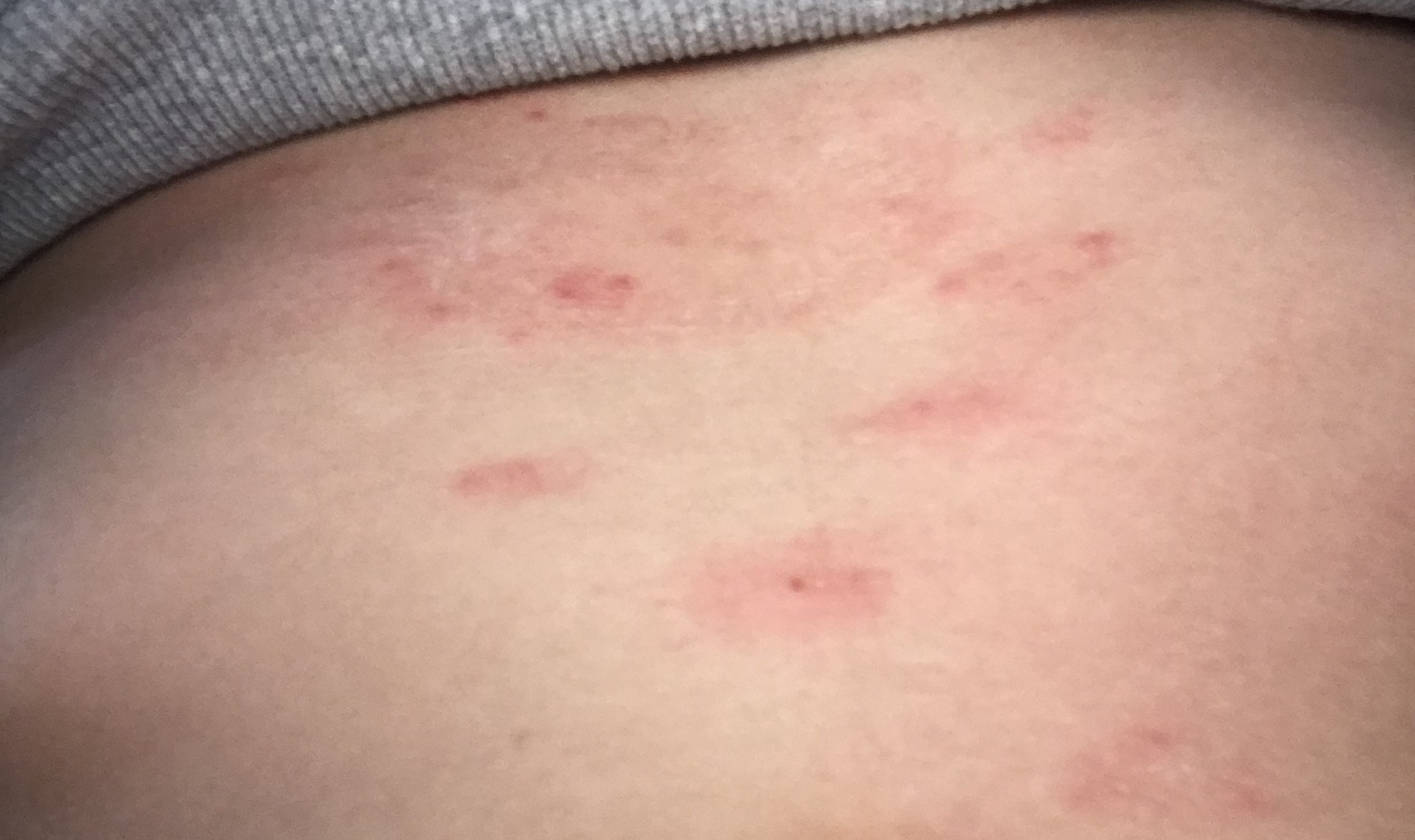 Ausschlag auf dem bauch was könnte es sein? (Gesundheit und Medizin Ausschlag auf dem bauch was könnte es sein? (Gesundheit und Medizin