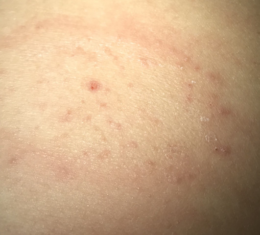 Ausschlag auf dem bauch was könnte es sein? (Gesundheit und Medizin Ausschlag auf dem bauch was könnte es sein? (Gesundheit und Medizin