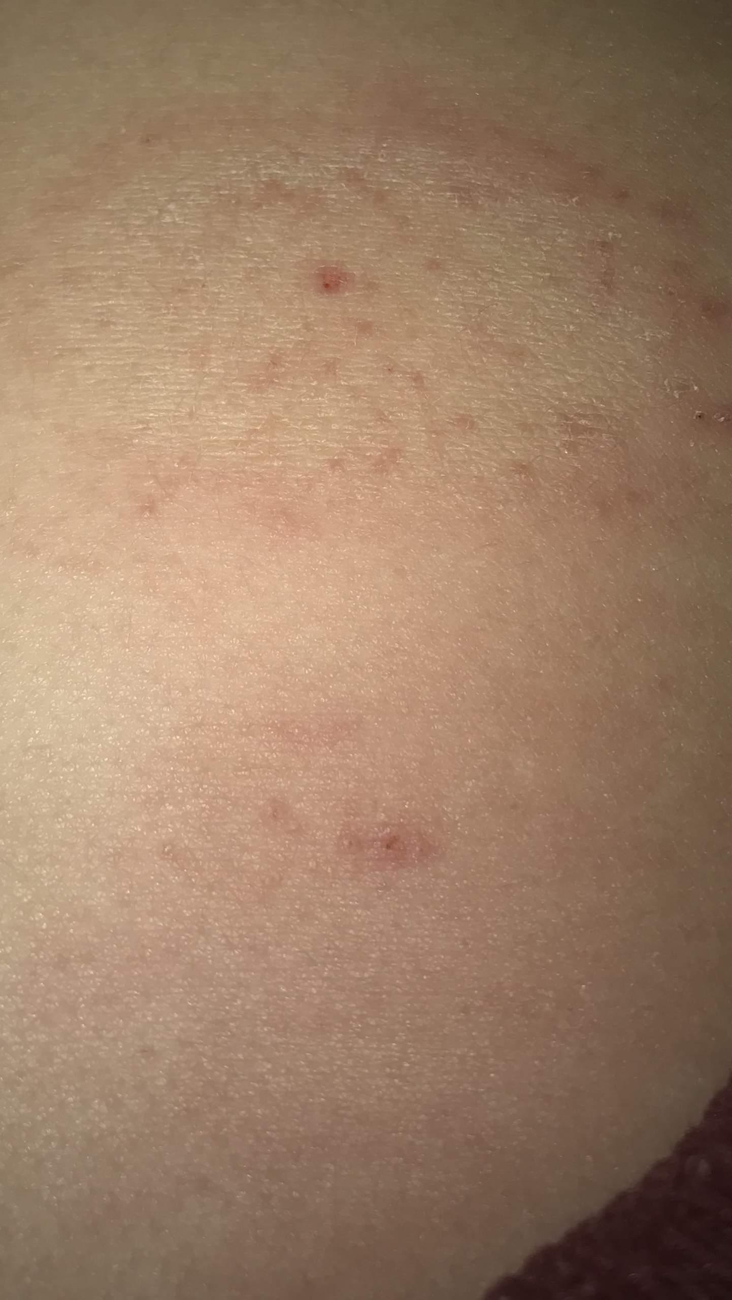 Ausschlag auf dem bauch was könnte es sein? (Gesundheit und Medizin, Krankheit, Haut)
