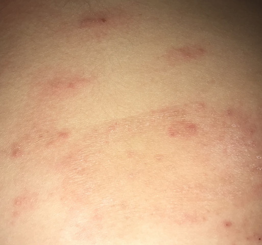 Ausschlag auf dem bauch was könnte es sein? (Gesundheit und Medizin Ausschlag auf dem bauch was könnte es sein? (Gesundheit und Medizin