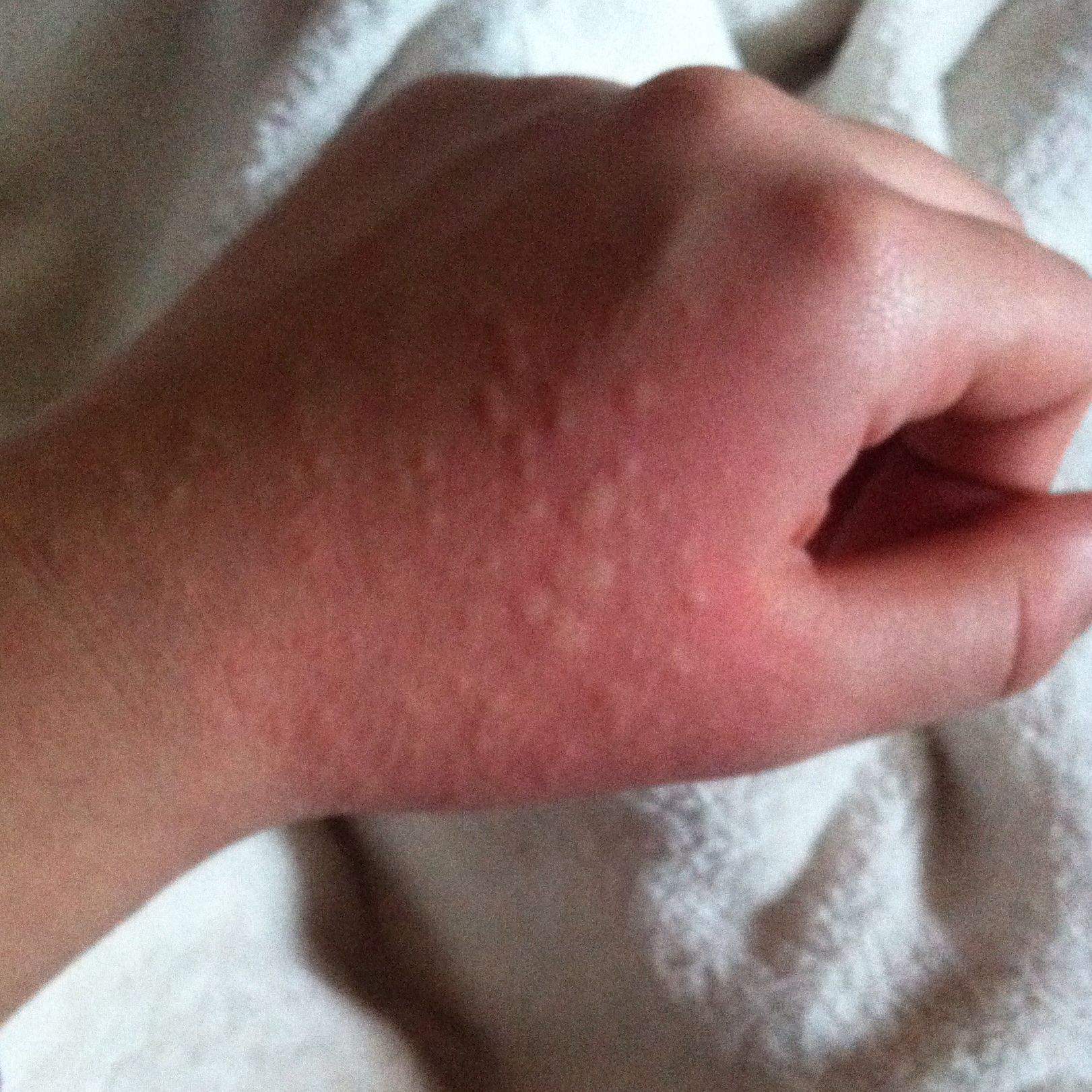 Ausschlag auf dem Handrcken, wichtig! (Hand, Hautausschlag, Ekel)