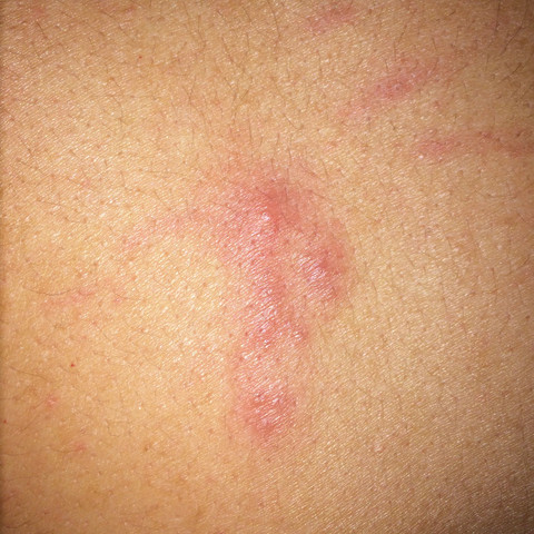 Ausschlag auf dem Rücken? (Arzt, Haut, Hautarzt)