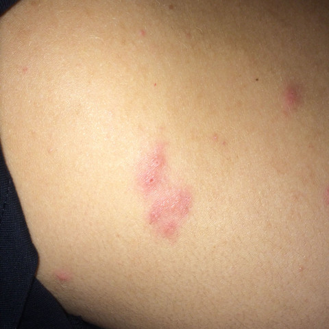 Ausschlag Auf Dem Rucken Arzt Haut Juckreiz Ausschlag Auf Dem Rucken Arzt Haut Juckreiz