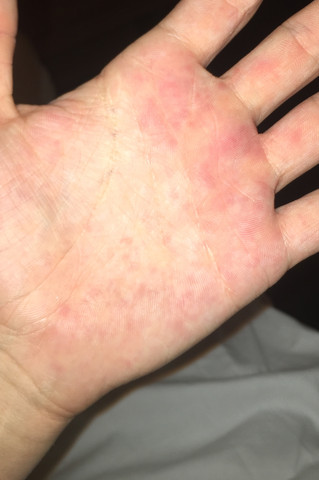 Ausschlag Auf Den Handen Was Tun Hand Ausschlag Auf Den Handen Was Tun Hand