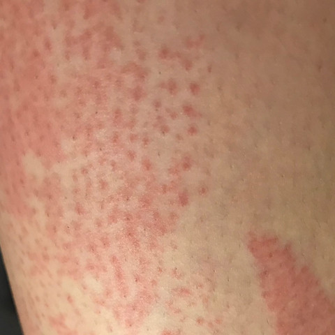 Ausschlag Bein Nach Rasieren Und Eincremen Gesundheit Und Medizin Beine Creme