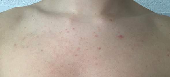 Ausschlag Brust Pickel? (Gesundheit und Medizin, Haut, Aussehen) Ausschlag Brust Pickel? (Gesundheit und Medizin, Haut, Aussehen)