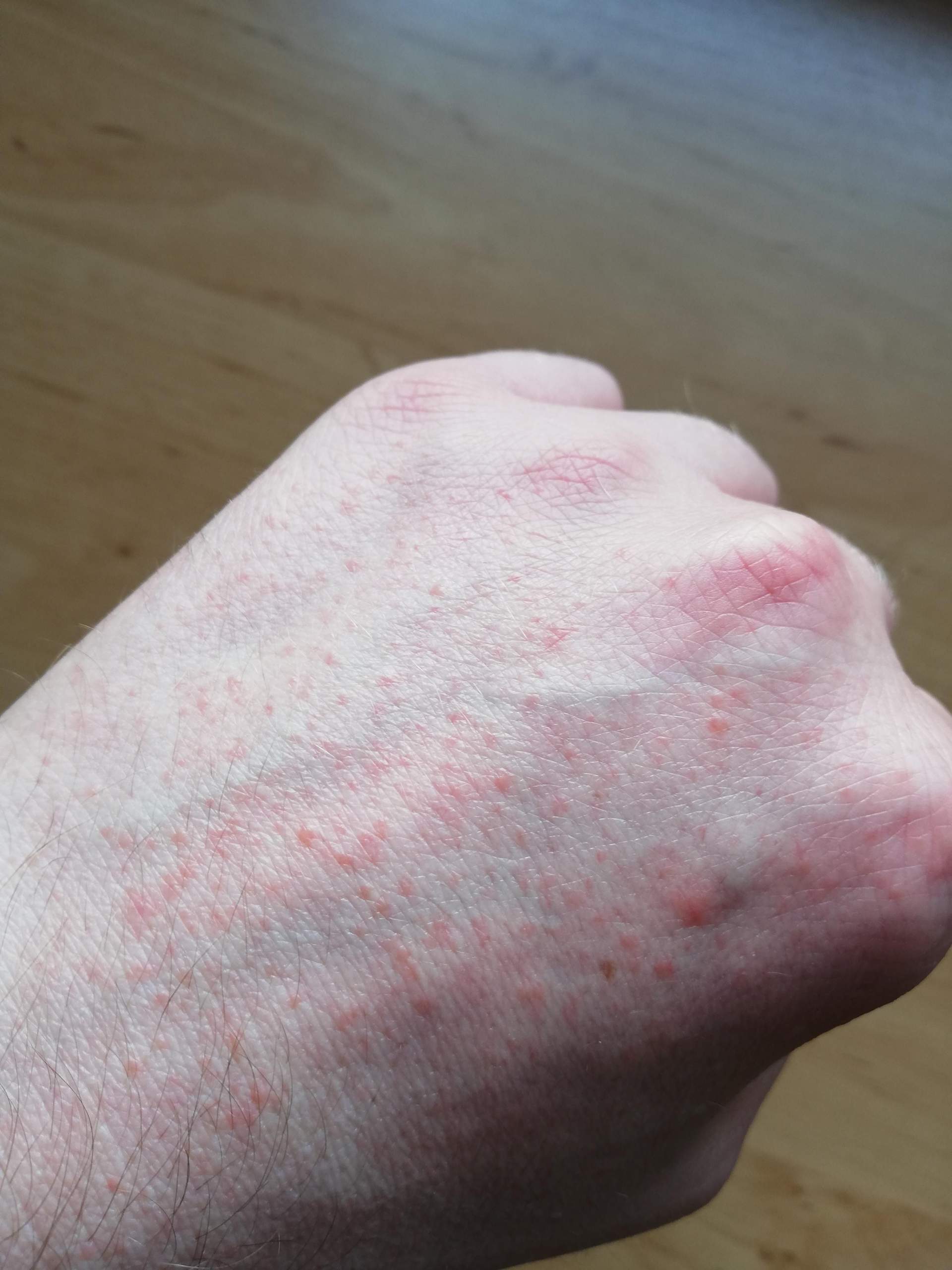 Ausschlag Handrücken? (Gesundheit)
