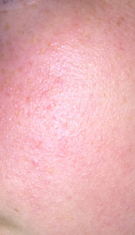 Ausschlag Im Gesicht Was Hilft Dagegen Gesundheit Und Medizin Hautarzt Ausschlag Im Gesicht Was Hilft Dagegen Gesundheit Und Medizin Hautarzt