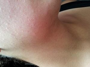 Im gesicht hals ausschlag und Hautausschlag: Ursachen,