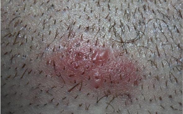 intimbereich mit wucherung mann