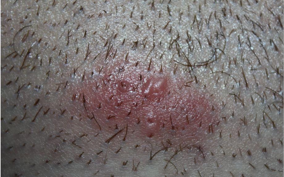 Ausschlag Im Intimbereich Mit Wucherung Mann Gesundheit Ausschlag Im Intimbereich Mit Wucherung Mann Gesundheit
