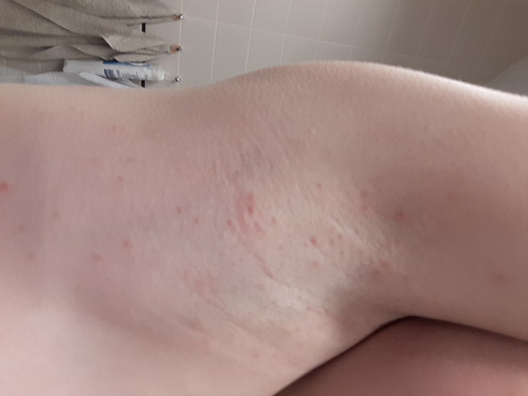 Ausschlag In Der Achsel Gesundheit Und Medizin Pullover Ausschlag In Der Achsel Gesundheit Und Medizin Pullover