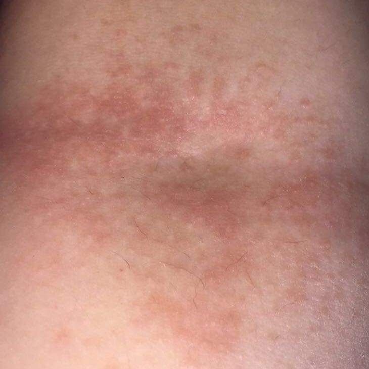 Ausschlag in der Ellenbeuge was ist das? (Gesundheit)