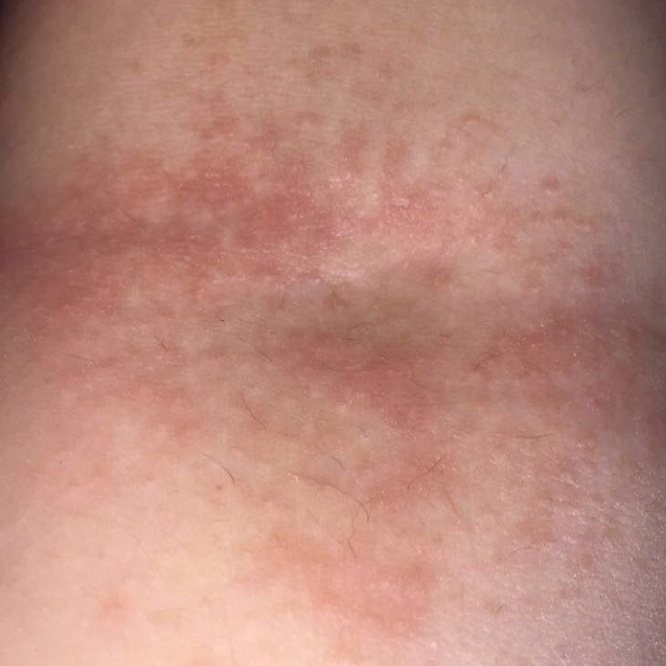 Ausschlag in der Ellenbeuge was ist das? (Gesundheit)