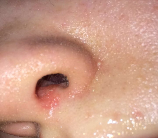 Ausschlag In Der Nase Mit Foto Bitte Hilfe Gesicht Infektion Hautprobleme Ausschlag In Der Nase Mit Foto Bitte Hilfe Gesicht Infektion Hautprobleme
