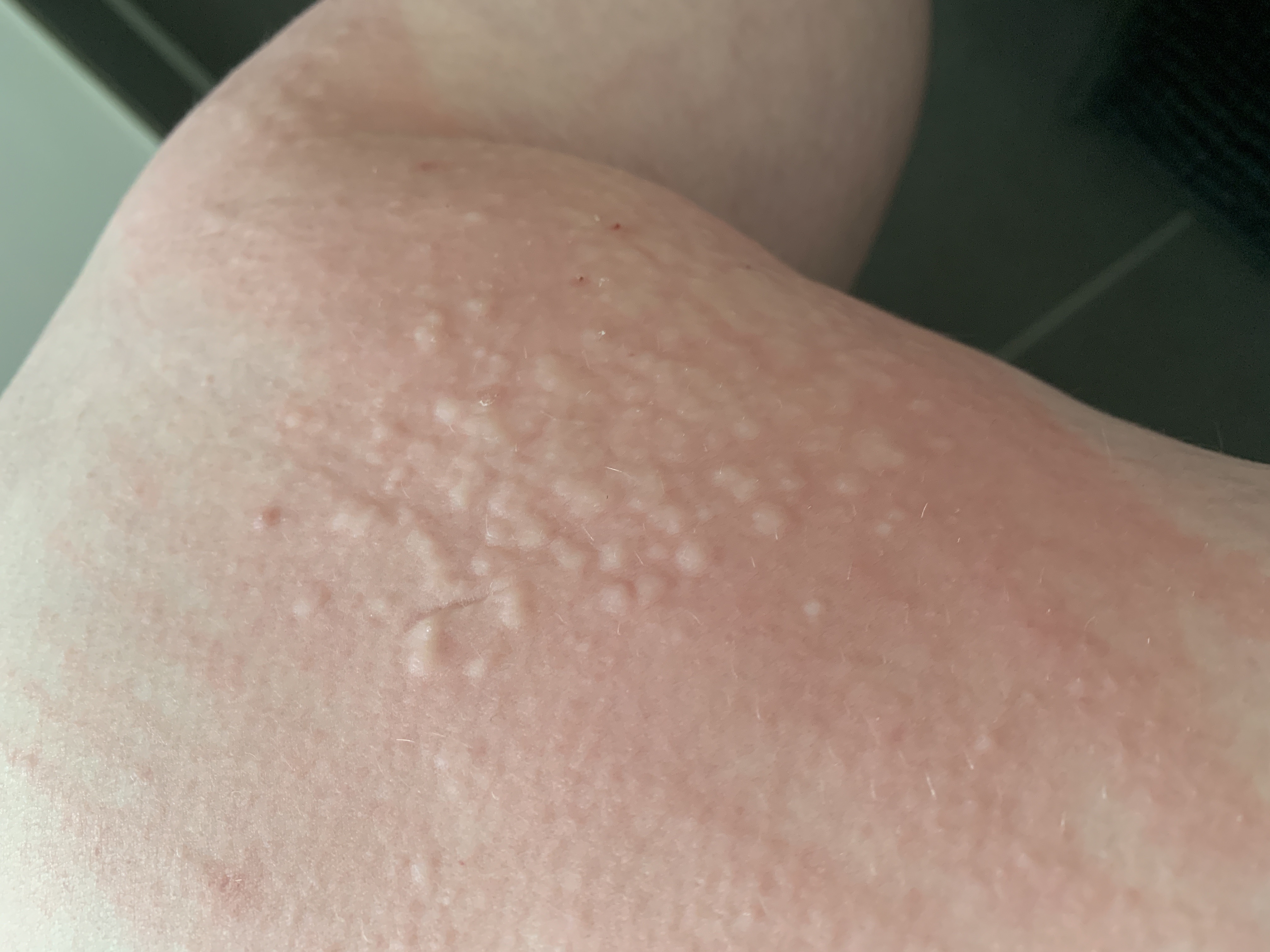 Ausschlag Juckreiz? (Gesundheit und Medizin, Medizin)