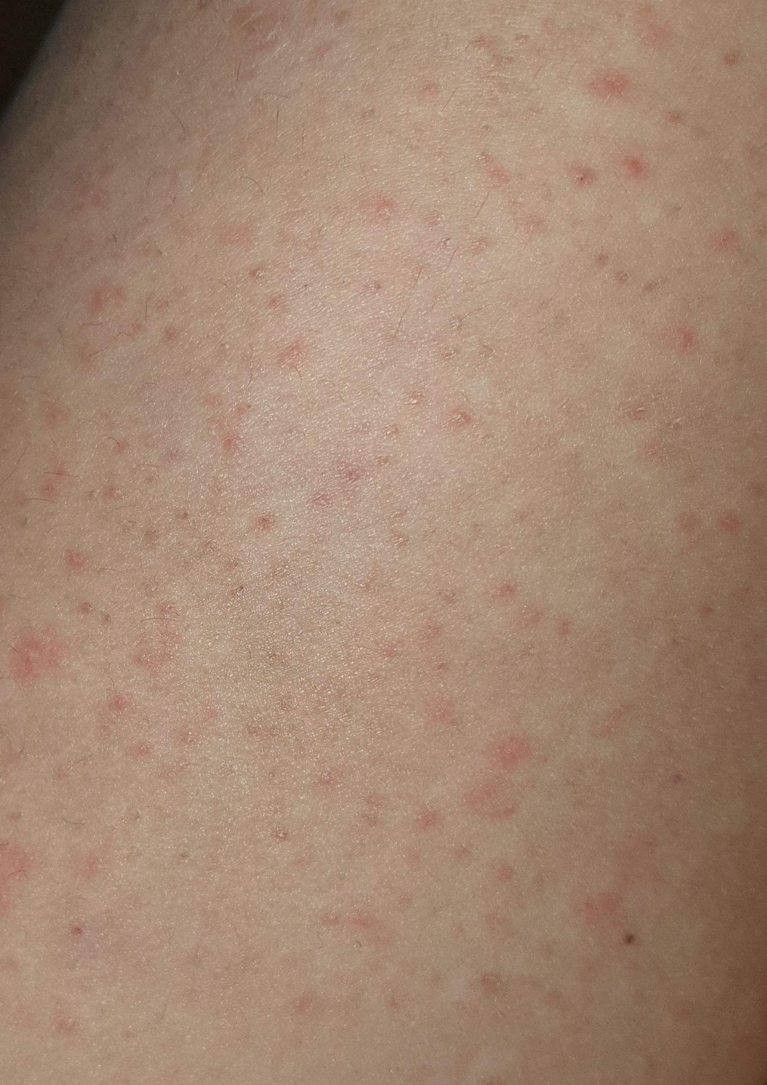 antibiotika amoxicillin 750 pille